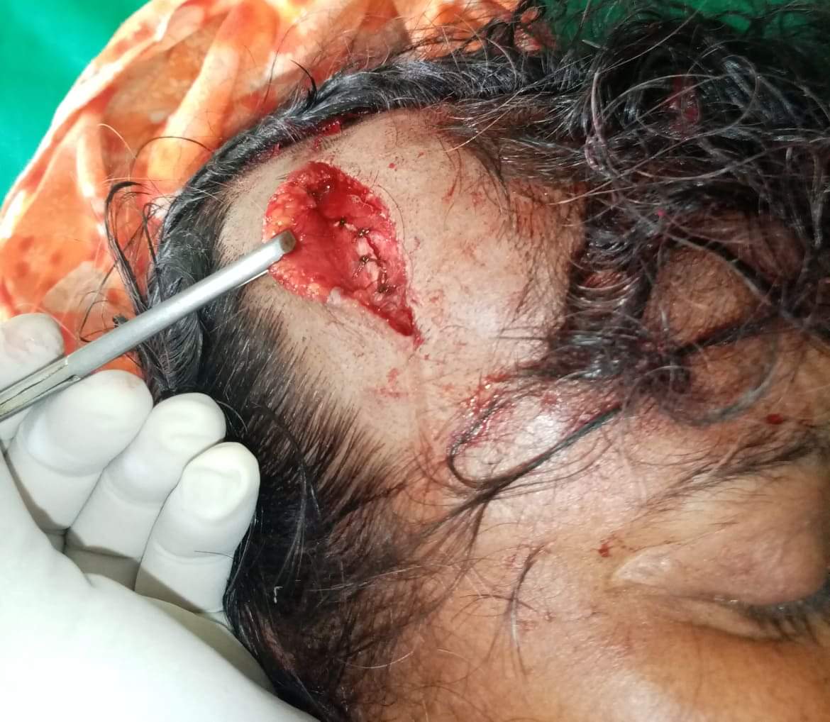 সোনাগাজীতে ঘাস কাটতে বাঁধা দেওয়াতে প্রতিপক্ষের হামলায় গৃহবধু গুরতর আহত